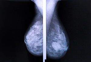 mammogram gr